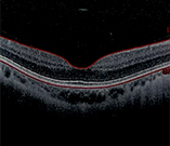 Diabetic Retinopathy