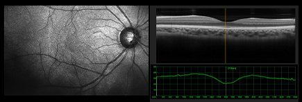 Macular Degeneration